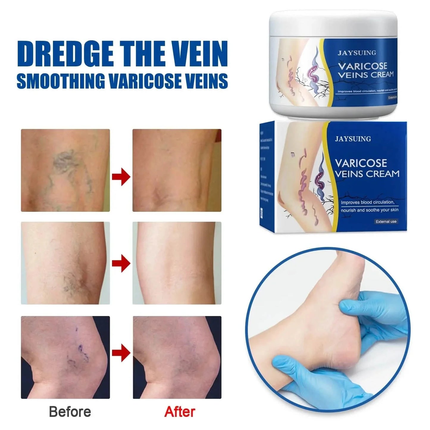 Pain Relief Leg Spider Veins Vasculitis Promote Circulation Smooth Metabolism 30g Exfoliation DailySale