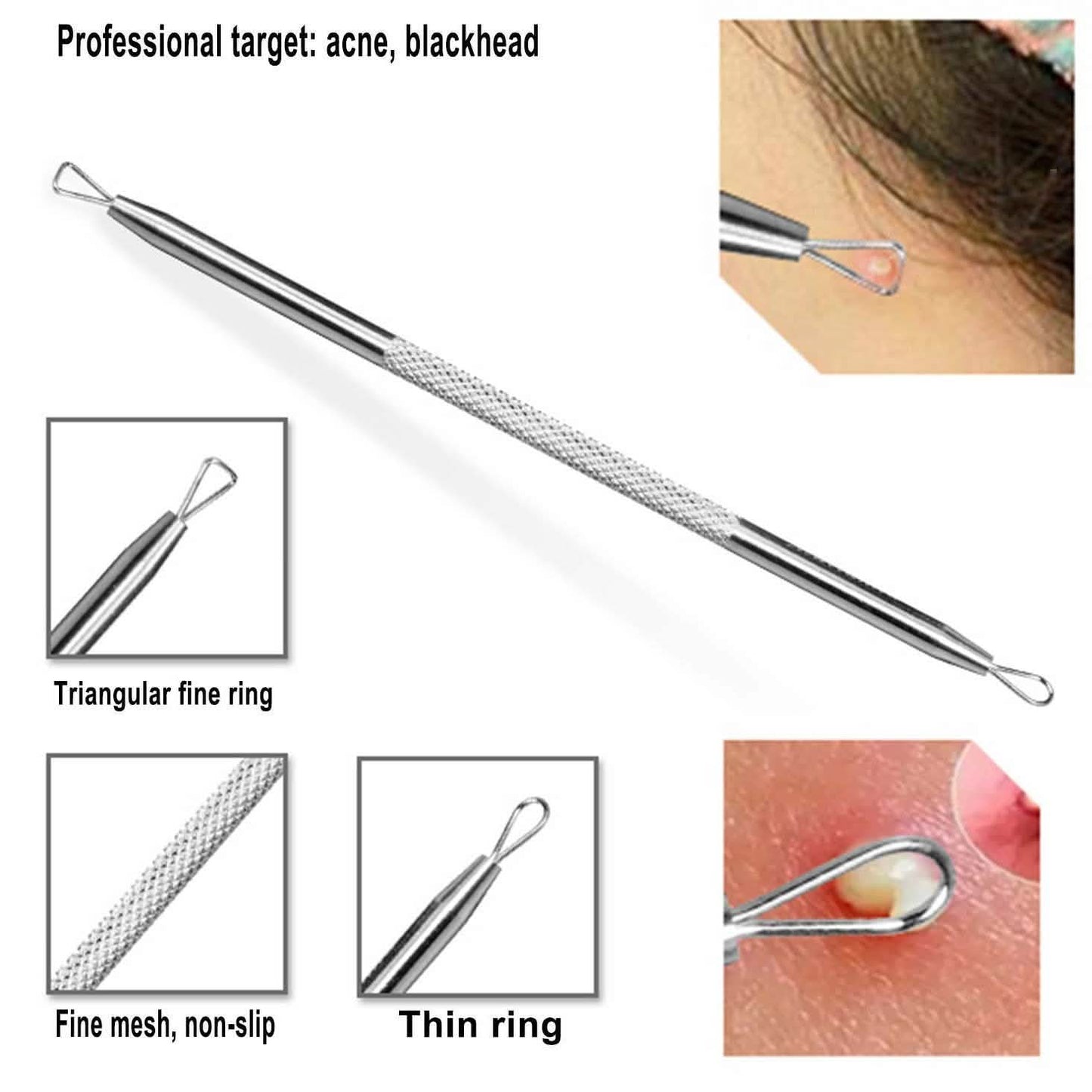6-Pieces Set: Blackhead Remover Comedones Extractor Acne Removal Kit DailySale