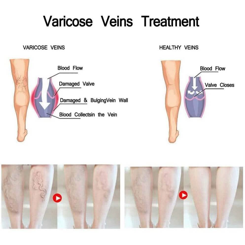 Varicose Deep Nourishing Soothing Vein Cream DailySale