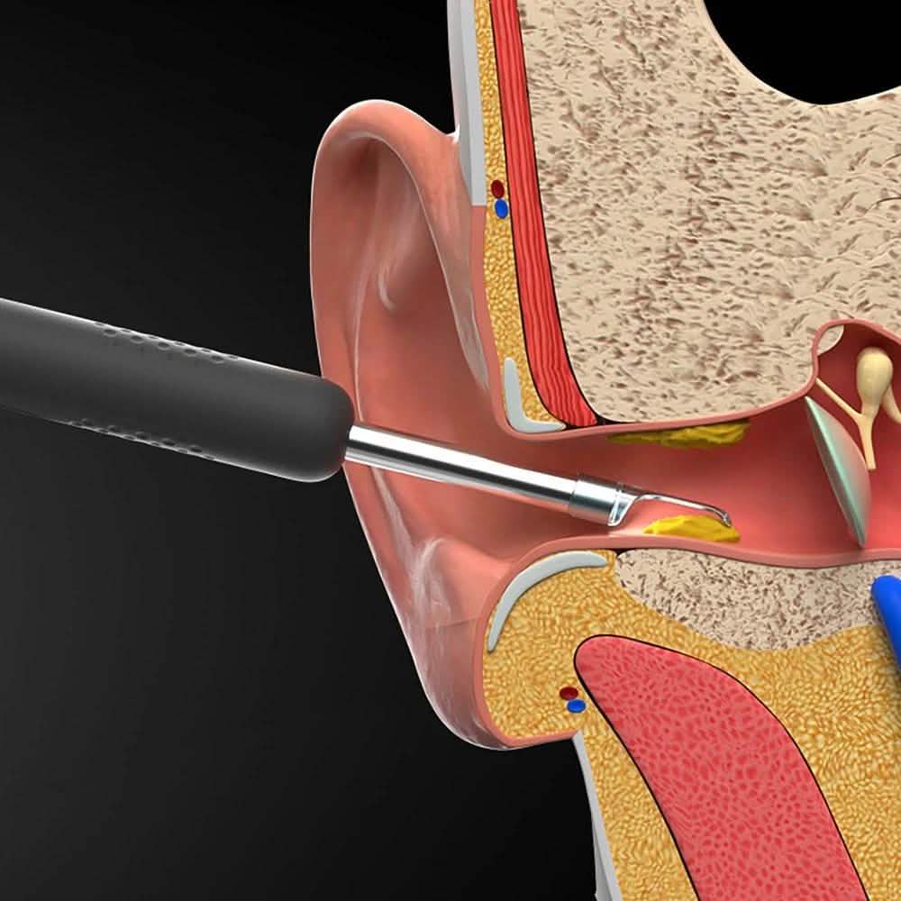 Bebird R1 Wireless Intelligent Visual Otoscope Ear Cleaner DailySale
