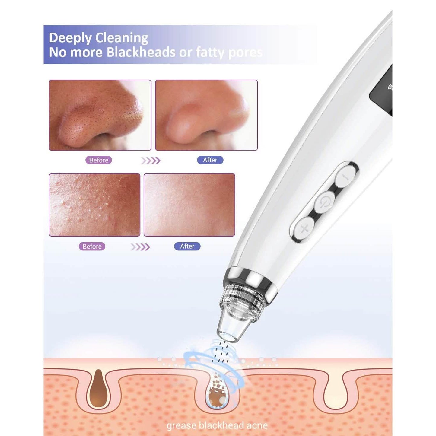 Blackhead Pore Vacuum Cleaner Remover DailySale