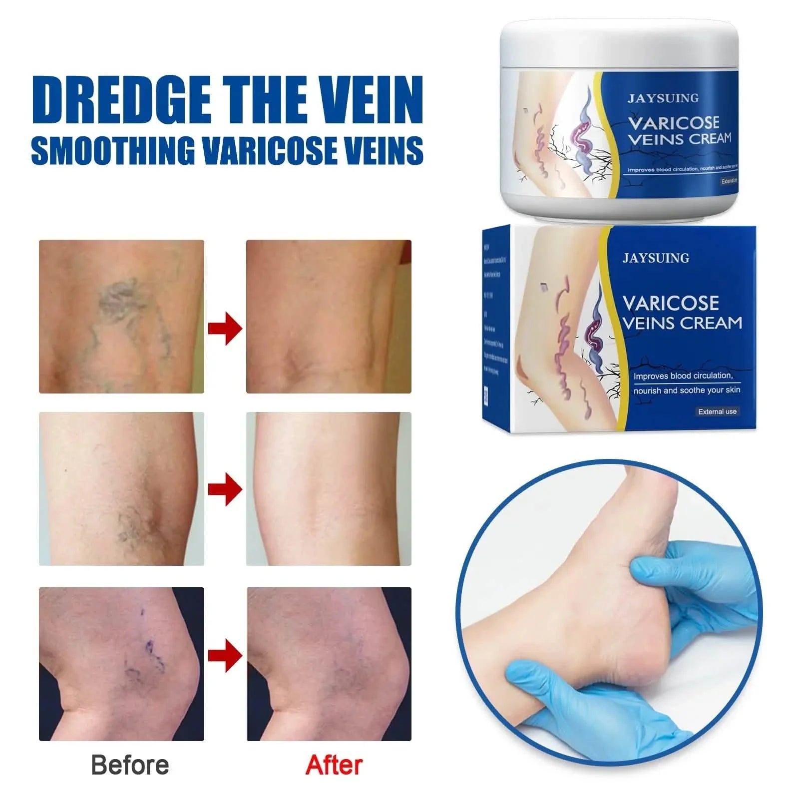 Pain Relief Leg Spider Veins Vasculitis Promote Circulation Smooth Metabolism 30g Exfoliation DailySale